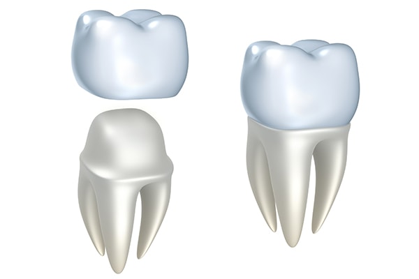 Crowns restore function and beauty to teeth