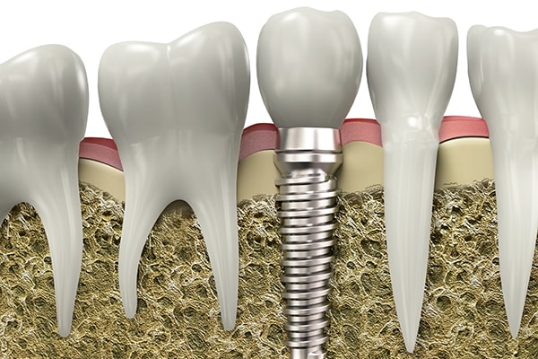 Dental implants replaces missing teeth.