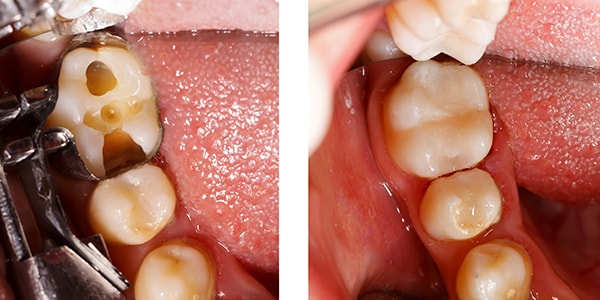 Fillings stops tooth decay from spreading. Here's an image of a dental filling being placed.