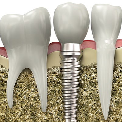 A graphic of a dental implant