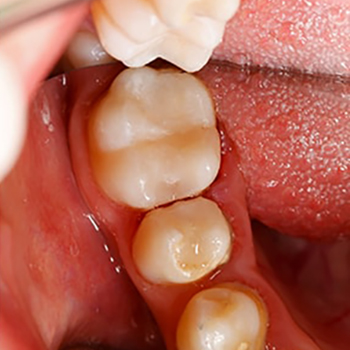 A close-up of a dental filling being placed
