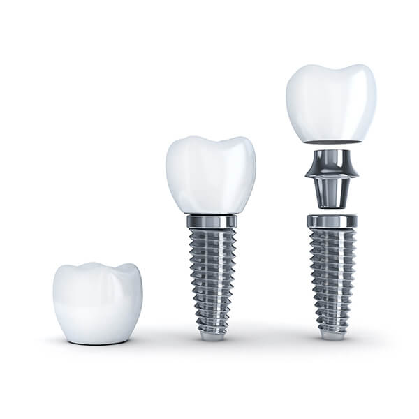 An illustration of a dental implant