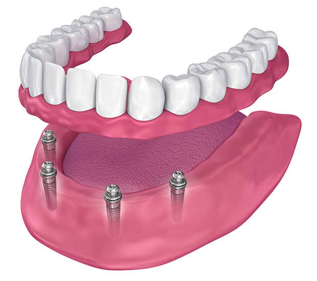 West Bloomfield Township All-on-4®