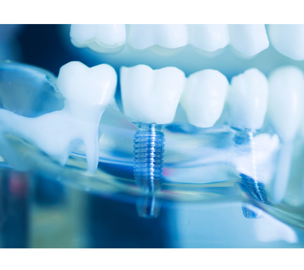 West Bloomfield Township Dental Implant Restoration