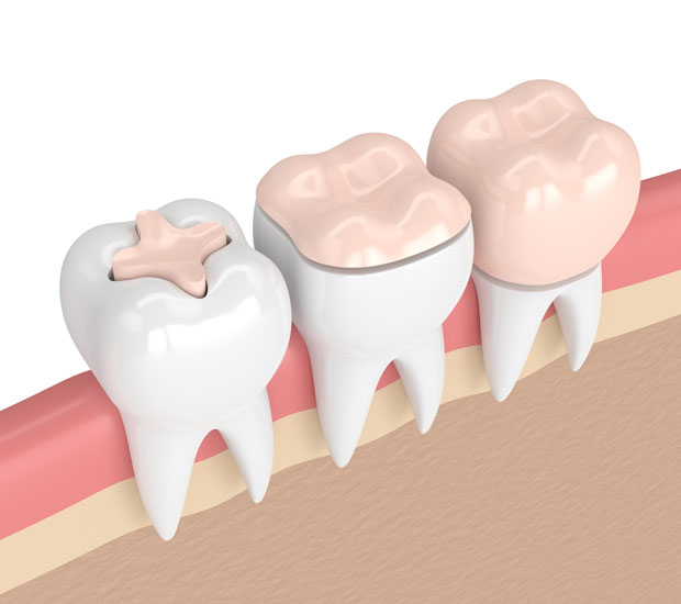 West Bloomfield Township Dental Inlays and Onlays