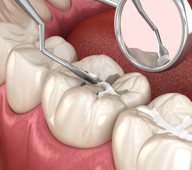 West Bloomfield Township Dental Sealants