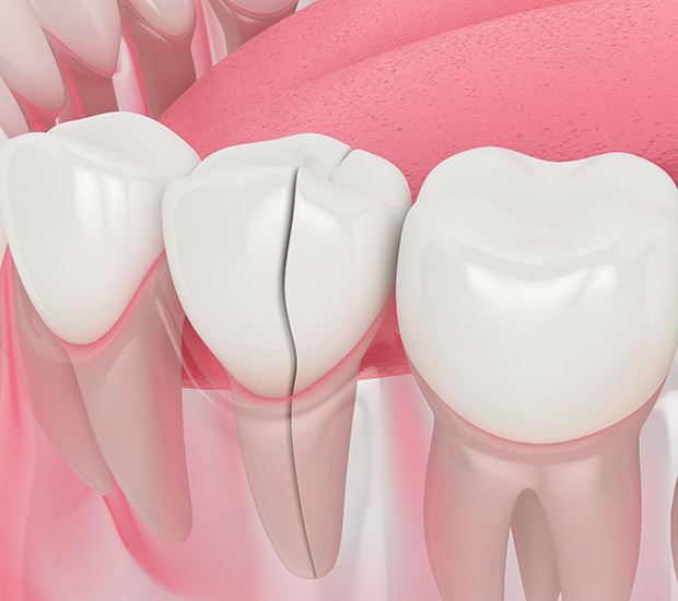 West Bloomfield Township Types of Dental Root Fractures